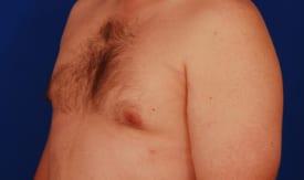 Gynecomastia Surgery Before & After Image