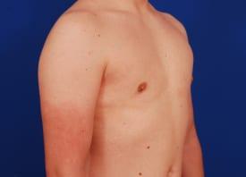Gynecomastia Surgery Before & After Image