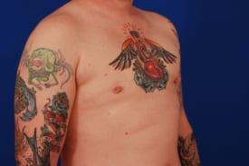 Gynecomastia Surgery Before & After Image