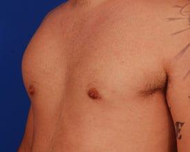 Gynecomastia Surgery Before & After Image