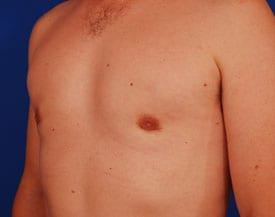 Gynecomastia Surgery Before & After Image