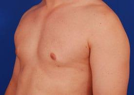 Gynecomastia Surgery Before & After Image