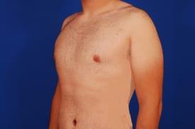 Gynecomastia Surgery Before & After Image
