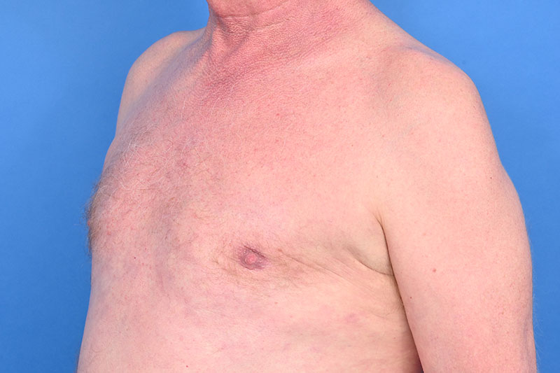 Gynecomastia Surgery Before & After Image