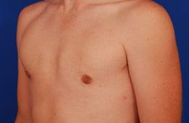 Gynecomastia Surgery Before & After Image