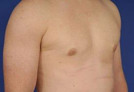 Gynecomastia Surgery Before & After Image