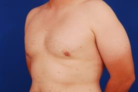 Gynecomastia Surgery Before & After Image