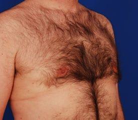 Gynecomastia Surgery Before & After Image