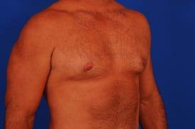 Gynecomastia Surgery Before & After Image
