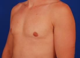 Gynecomastia Surgery Before & After Image