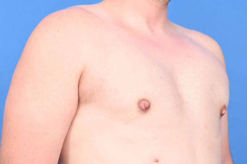 Gynecomastia Surgery Before & After Image