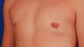 Gynecomastia Surgery Before & After Image