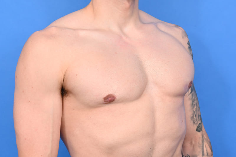 Gynecomastia Surgery Before & After Image