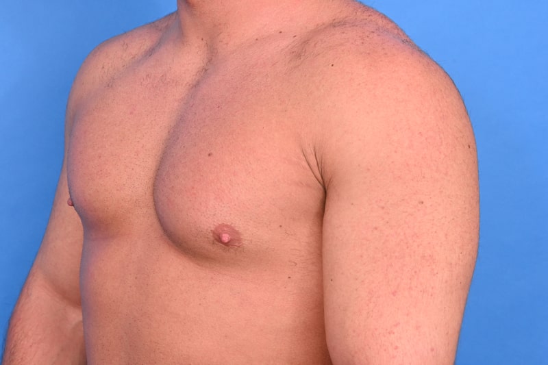 Gynecomastia Surgery Before & After Image