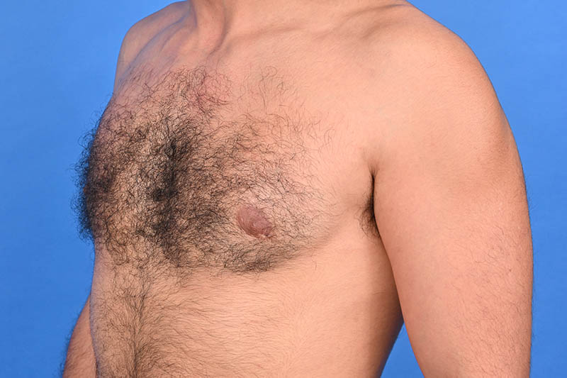 Gynecomastia Surgery Before & After Image