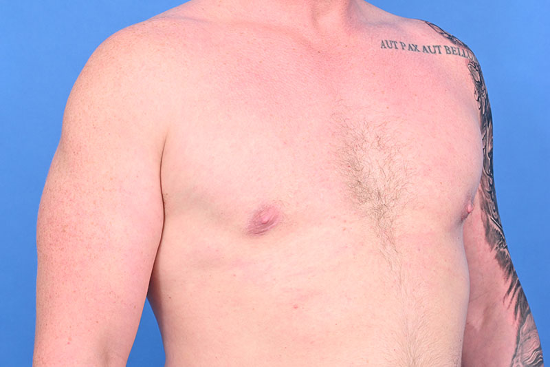 Gynecomastia Surgery Before & After Image