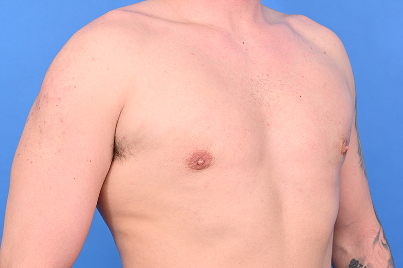 Gynecomastia Surgery Before & After Image