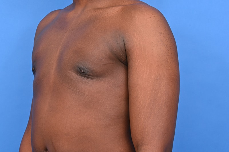 Gynecomastia Surgery Before & After Image