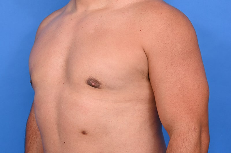 Gynecomastia Surgery Before & After Image