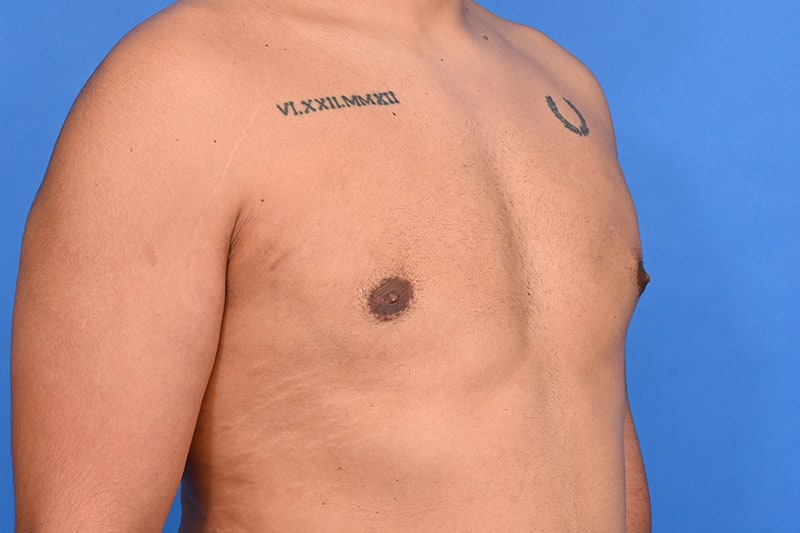 Gynecomastia Surgery Before & After Image