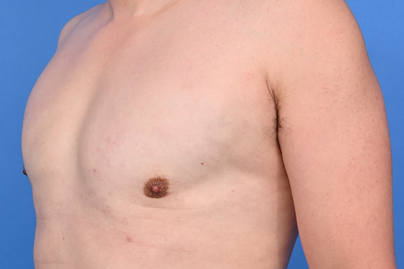 Gynecomastia Surgery Before & After Image