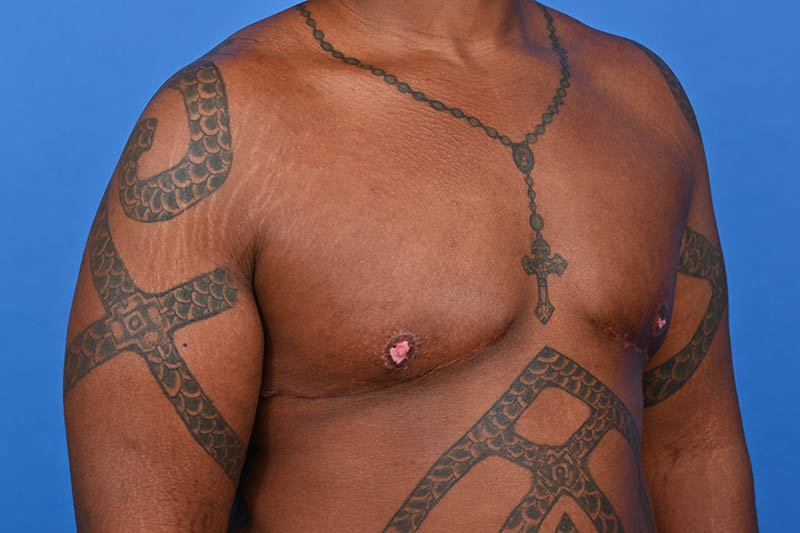 Gynecomastia Surgery Before & After Image