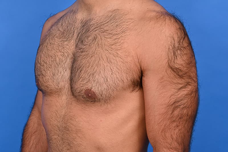 Gynecomastia Surgery Before & After Image