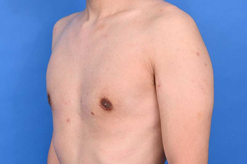 Gynecomastia Surgery Before & After Image