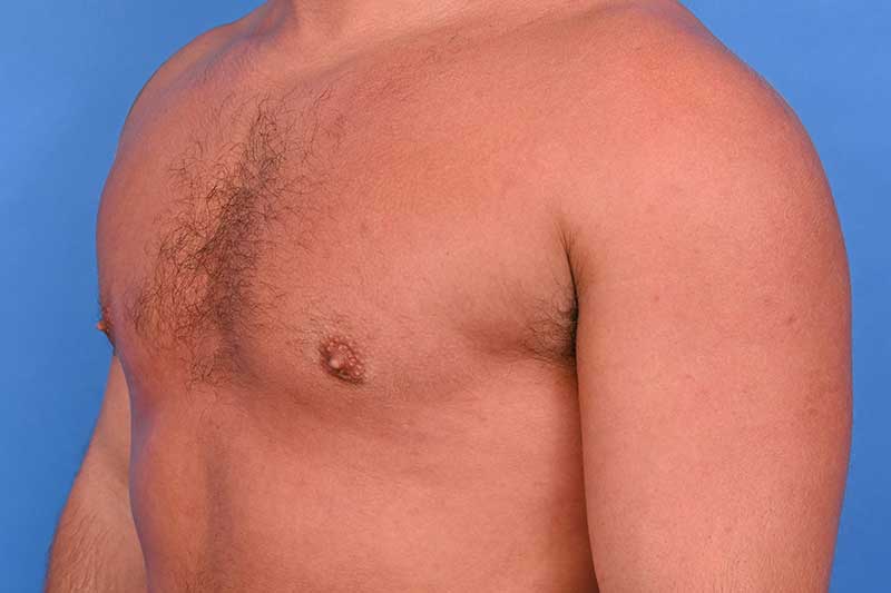 Gynecomastia Surgery Before & After Image