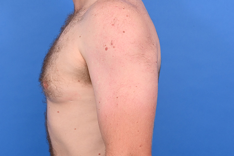 Gynecomastia Surgery Before & After Image
