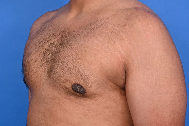 Gynecomastia Surgery Before & After Image