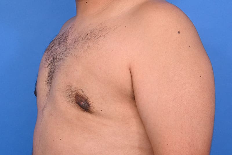 Gynecomastia Surgery Before & After Image