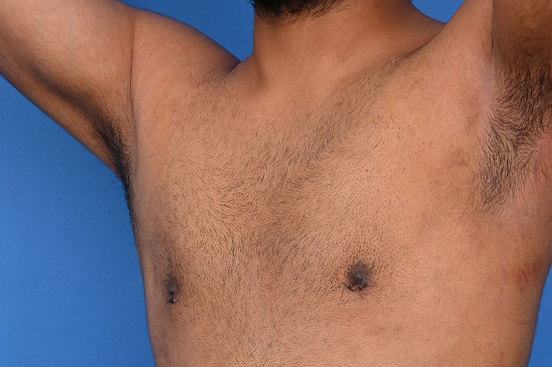 Gynecomastia Surgery Before & After Image