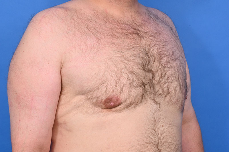 Gynecomastia Surgery Before & After Image