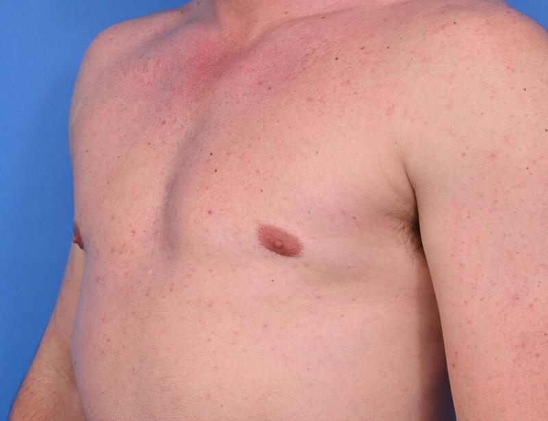 Gynecomastia Surgery Before & After Image