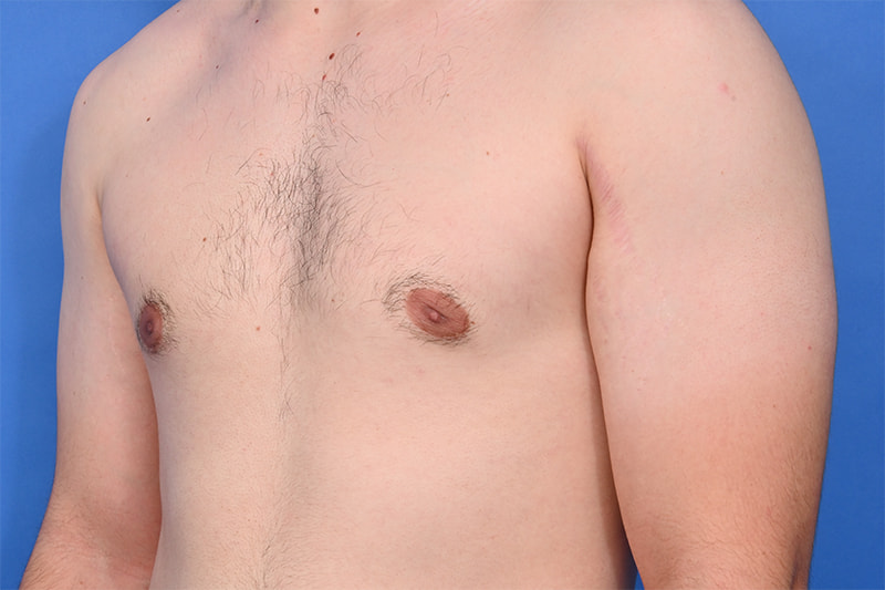 Gynecomastia Surgery Before & After Image