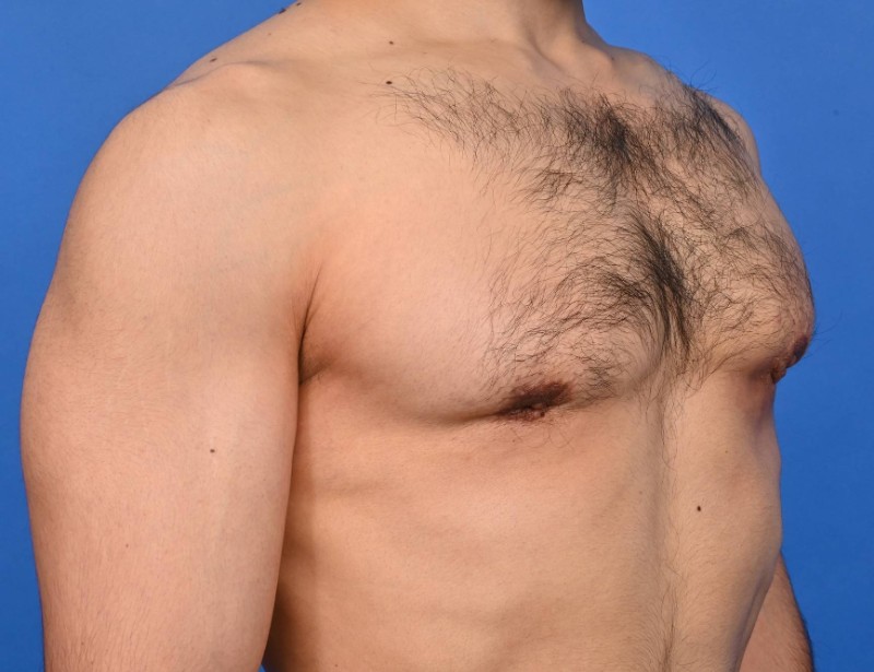 Gynecomastia Surgery Before & After Image
