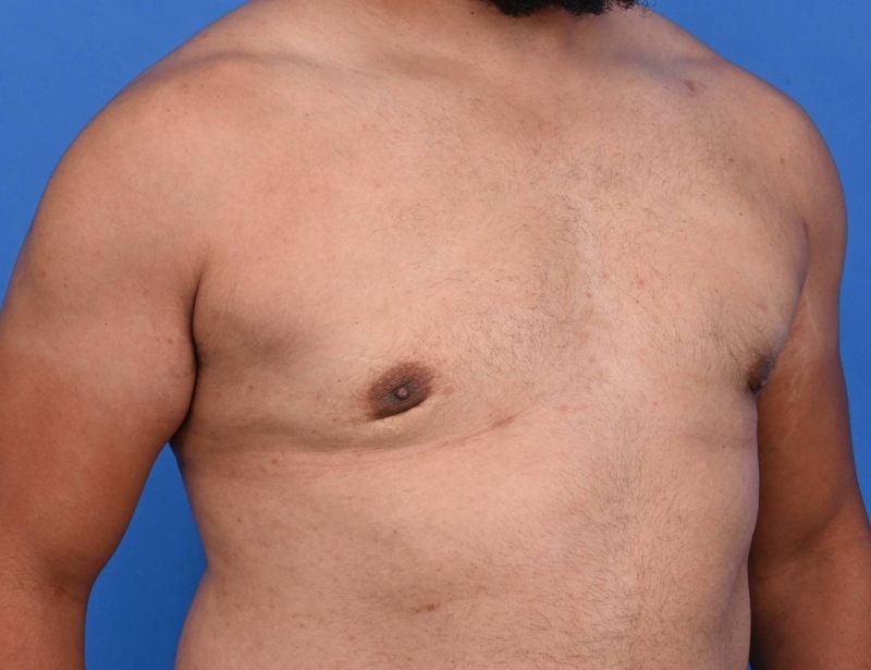 Gynecomastia Surgery Before & After Image