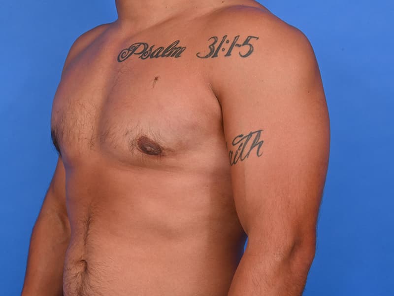 Gynecomastia Surgery Before & After Image