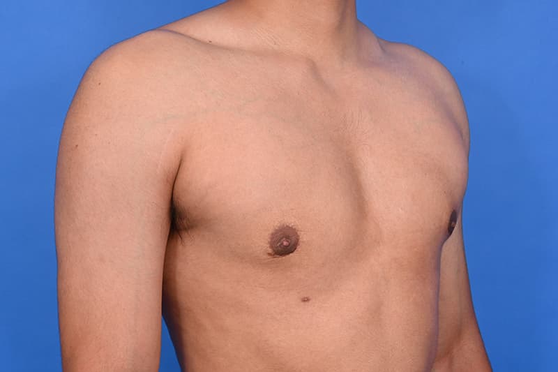 Gynecomastia Surgery Before & After Image