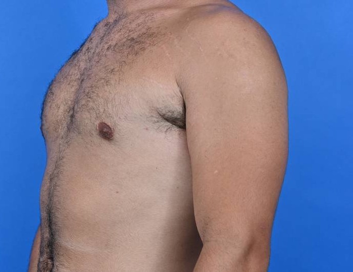 Gynecomastia Surgery Before & After Image