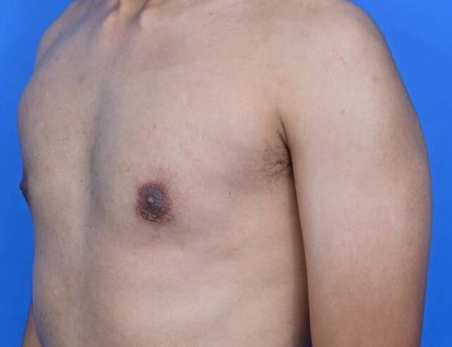 Gynecomastia Surgery Before & After Image