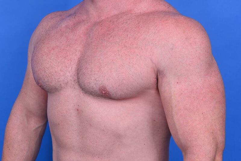 Gynecomastia Surgery Before & After Image