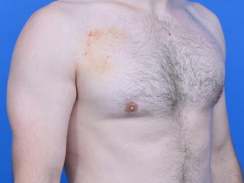 Gynecomastia Surgery Before & After Image