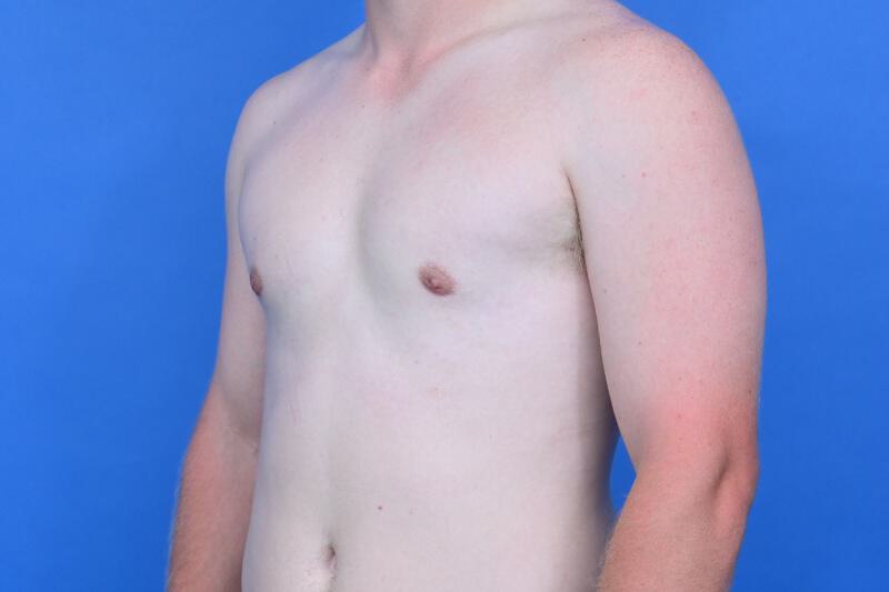 Gynecomastia Surgery Before & After Image