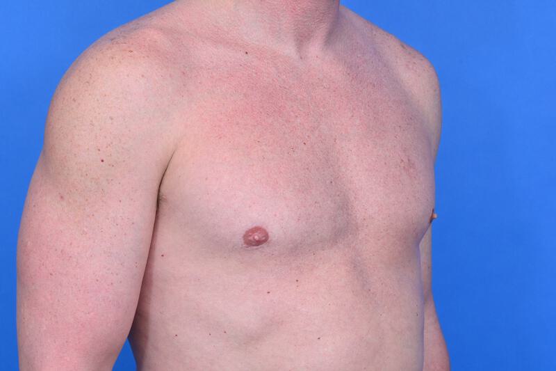 Gynecomastia Surgery Before & After Image