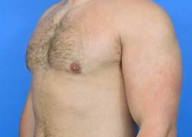 Gynecomastia Surgery Before & After Image