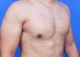 Gynecomastia Surgery Before & After Image
