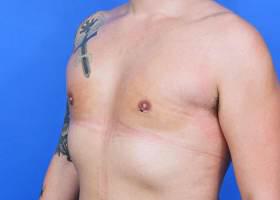 Gynecomastia Surgery Before & After Image