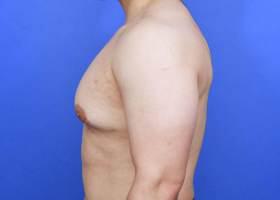 Gynecomastia Surgery Before & After Image